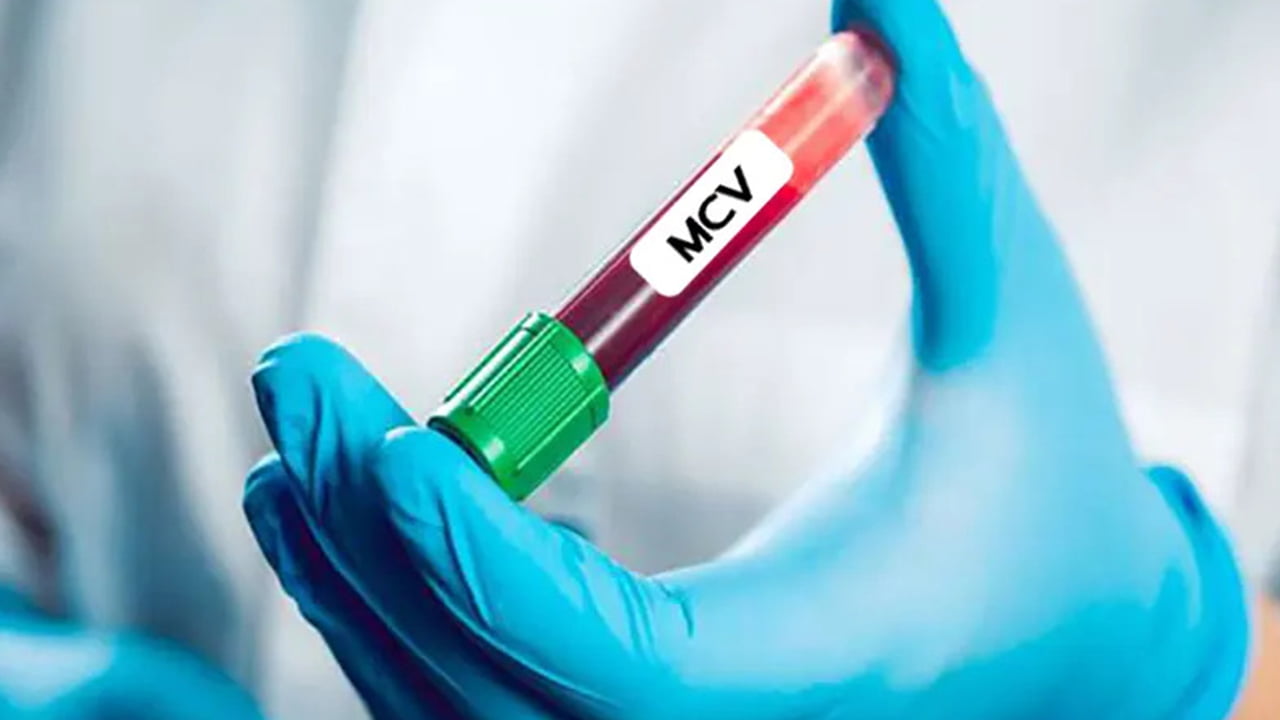 MCV در آزمایش خون
