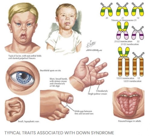 سندرم داون